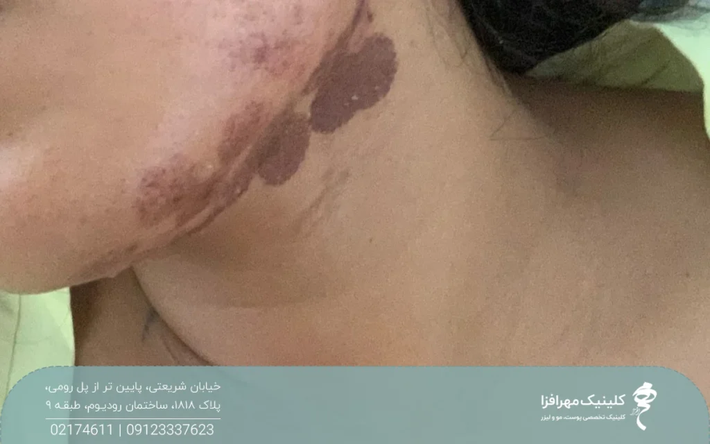 گردن فردی که بعد از لیزر موهای زائد سوخته است