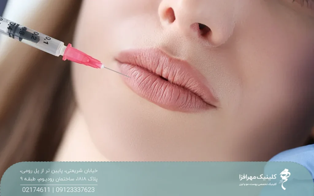 لب های دختری که روی تخت کلینیک است و پزشک به لب پایین او فیلر تزریق می کند