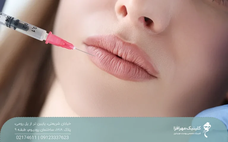 لب های دختری که روی تخت کلینیک است و پزشک به لب پایین او فیلر تزریق می کند