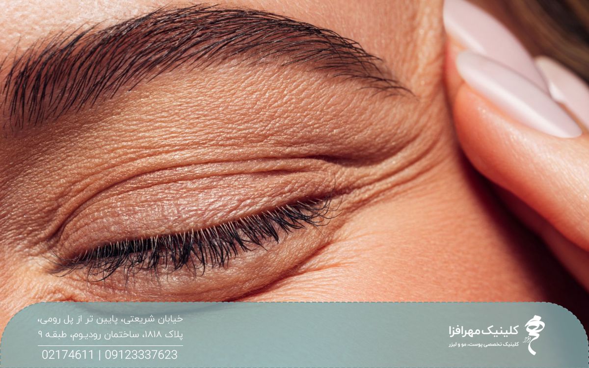 چشم دختری که اطراف چشم او چروک شده و خطوط نمایان شده است