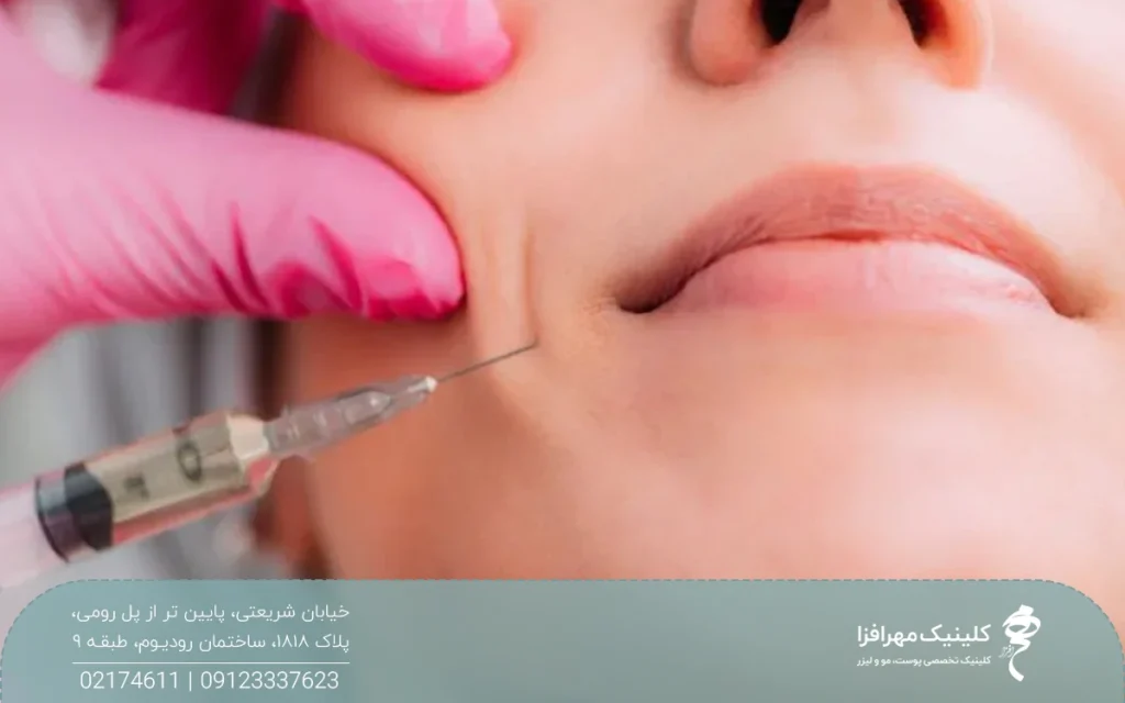 دستان دکتری که درحال تزریق چربی خط خنده بر روی صورت فرد است