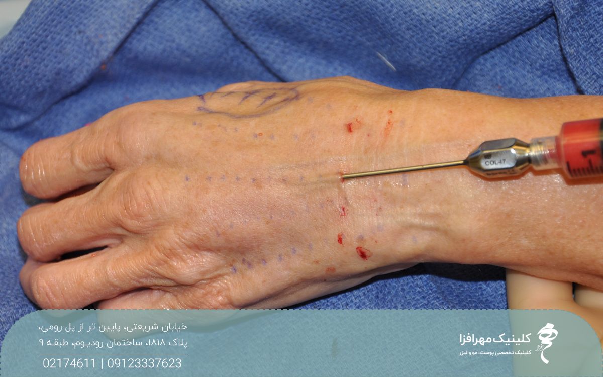 نحوه تزریق چربی به دست مراجعه کننده با سرنگ
