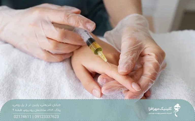دستان پزشکی که به دست مراجعه کننده چربی تزریق می کند
