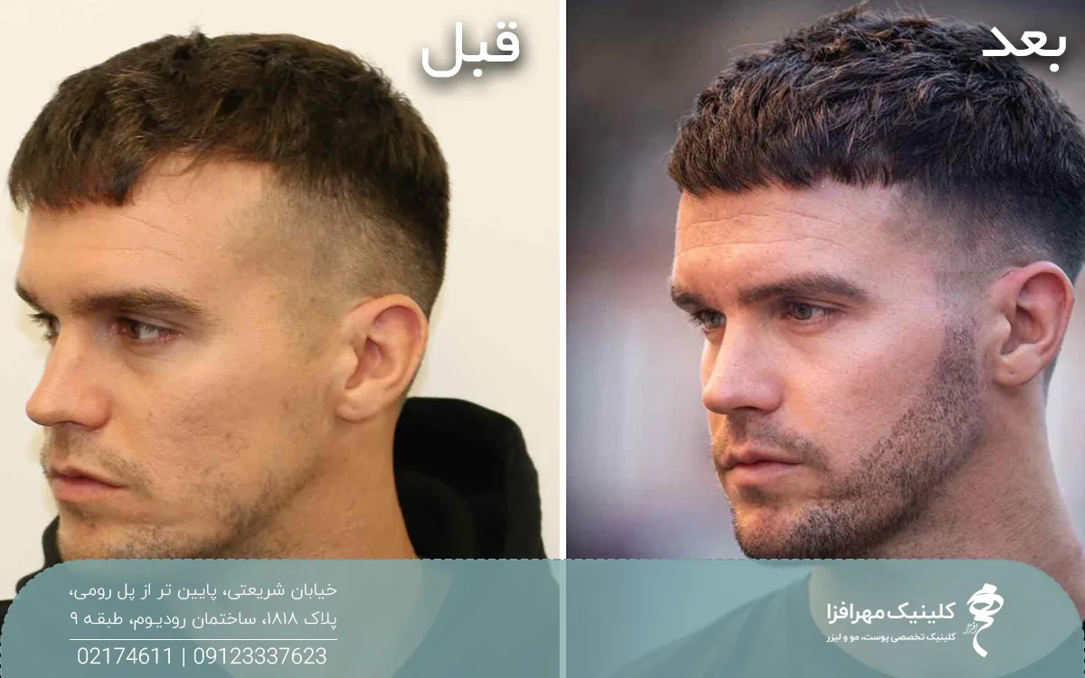 عکس قبل و بعد فردی که کاشت ریش انجام داده است