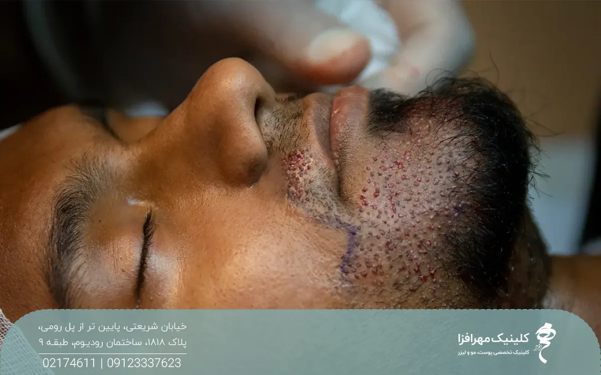 مردی که چشم هایش را بسته و تازه کاشت ریش انجام داده است