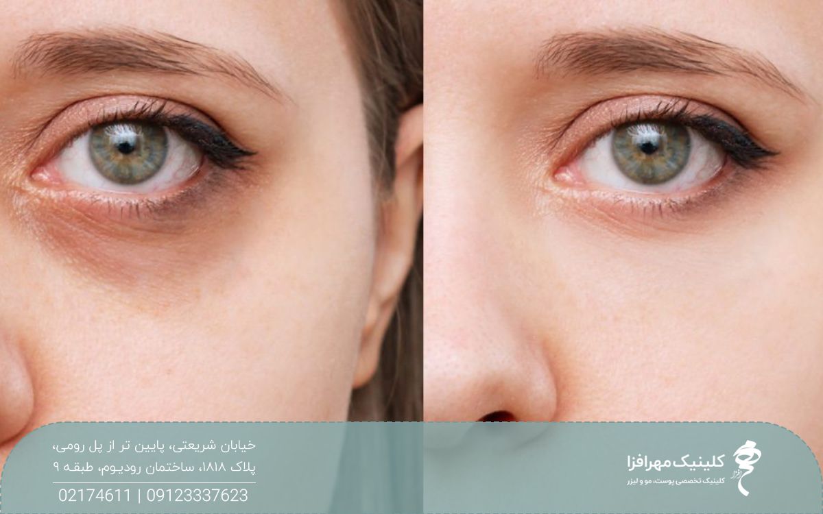 عکس قبل و بعد تزریق مزوژل زیر چشم که باعث رفع کبودی و فرورفتگی زیر چشم دختر شده است