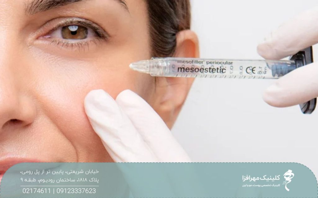 عکس نزدیک از چشم راست دختری که پزشک زیر چشم او مزوژل تزریق می کند