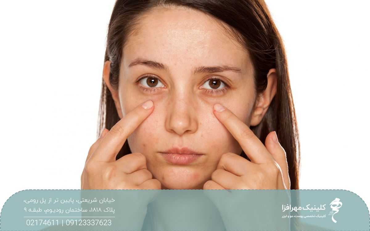 دختری که زیر چشم هایش گودی و تیرگی وجود دارد و با انگشت اشاره زیر چشم های خود را نشان می دهد