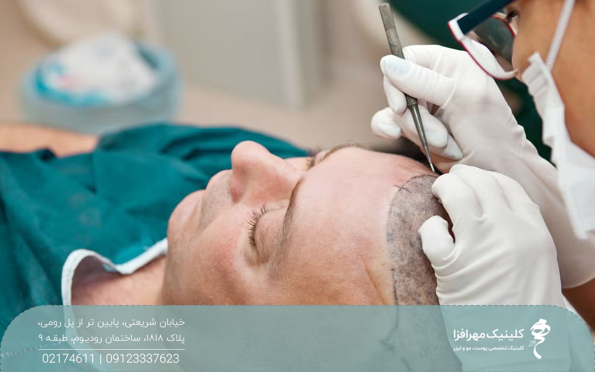 مردی که دراز کشیده و چشم هایش بسته است و پزشک با ابزار پانج کاشت مو میکروگرافت انجام می دهد