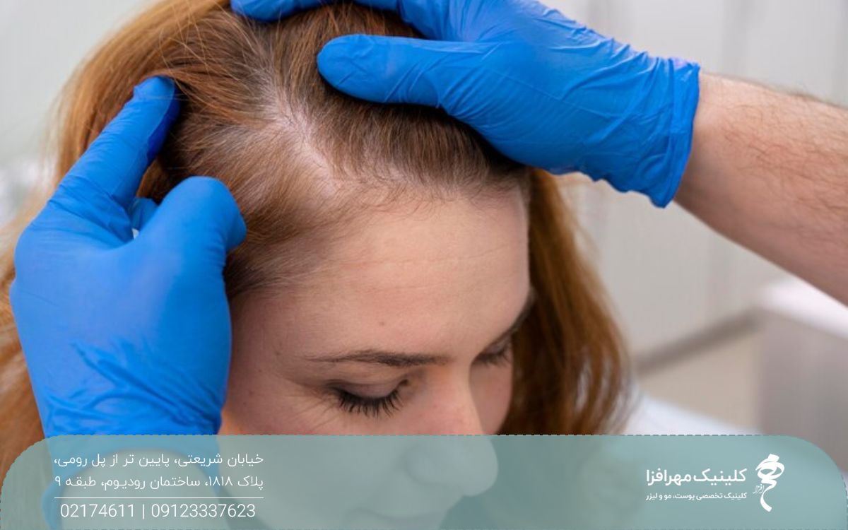 دختری که موهای ناحیه فرق و شقیقه او کم پشت شده است و پزشک موهای سر او را معاینه می کند