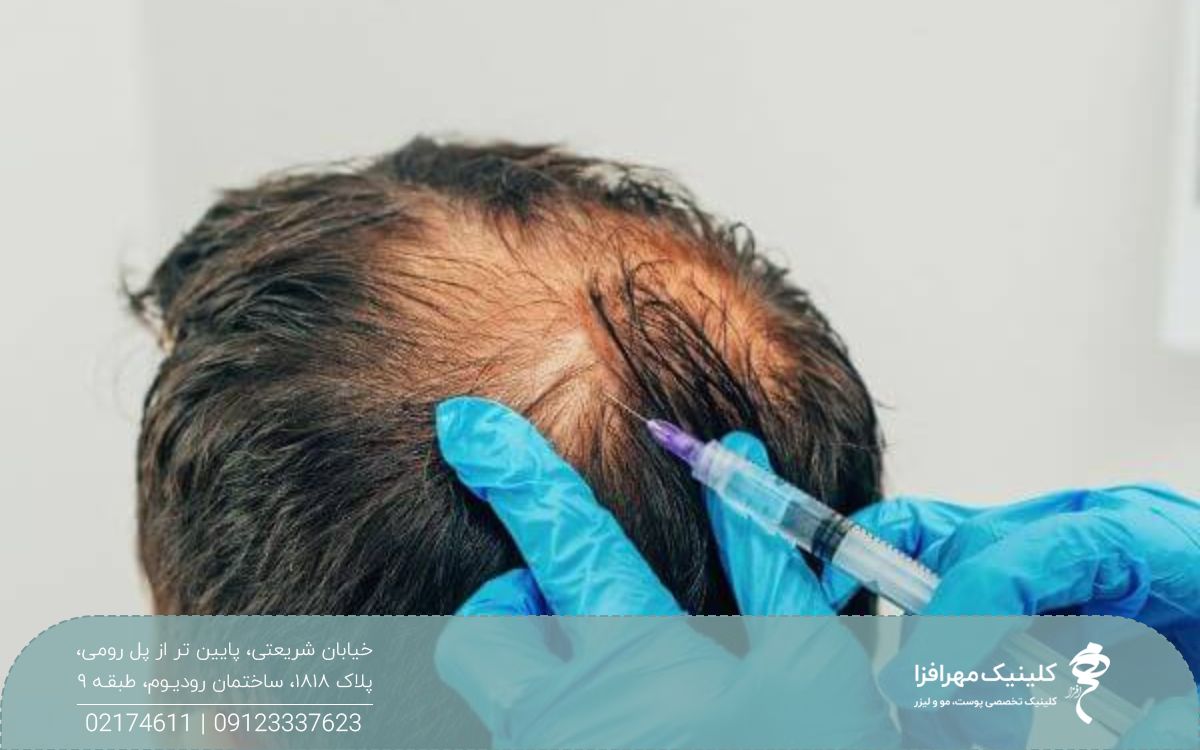 پزشکی که به ناحیه طاسی سر مرد تزریق انجام می دهد