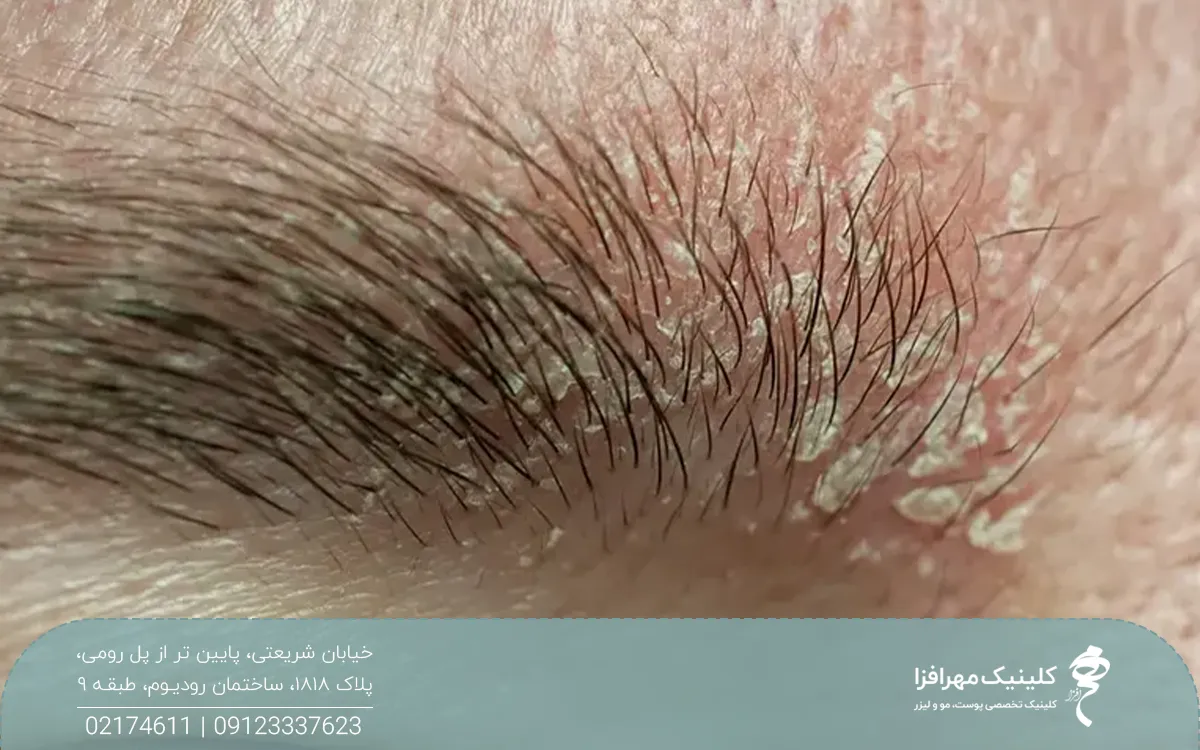 ابروهای فردی که پوسته پوسته شده است