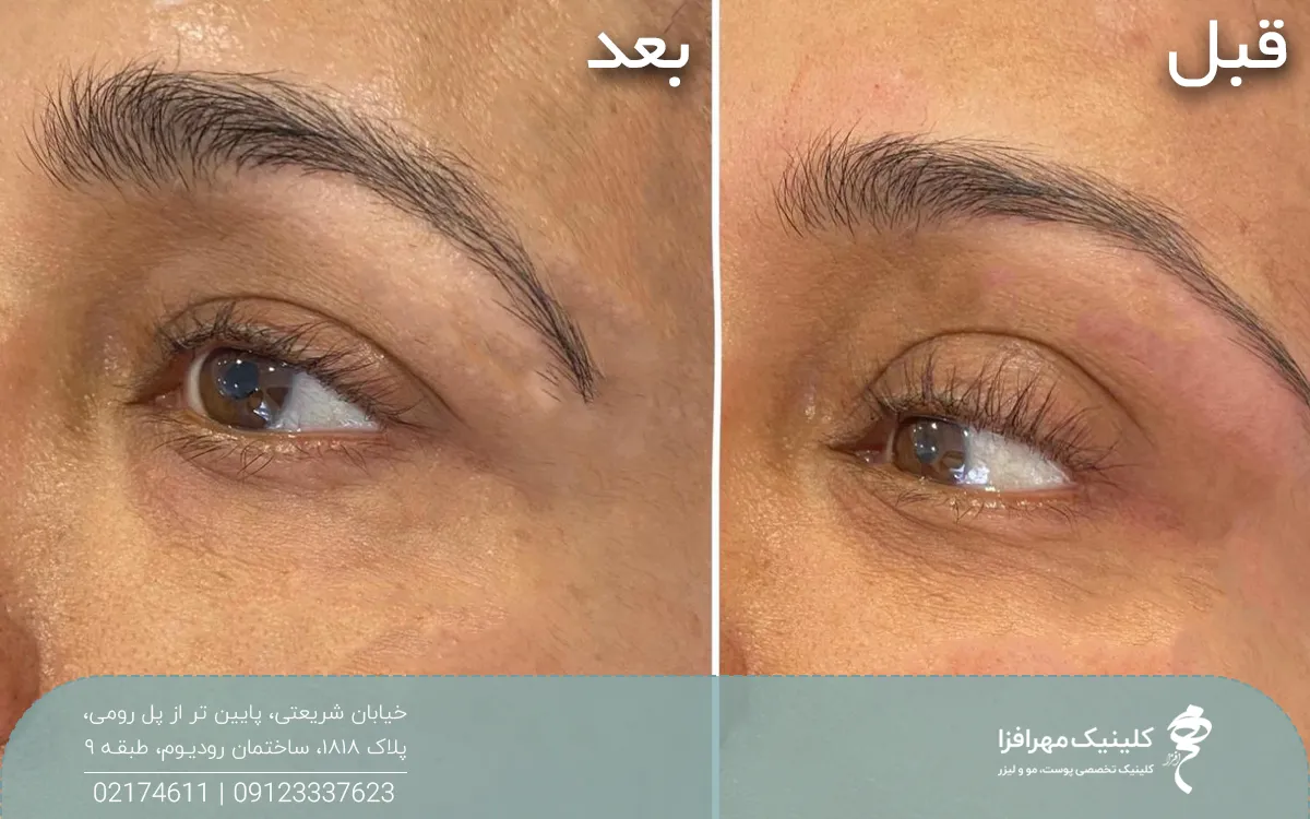 عکس قبل و بعد فردی که بوتاکس چشم گربه ای انجام داده است