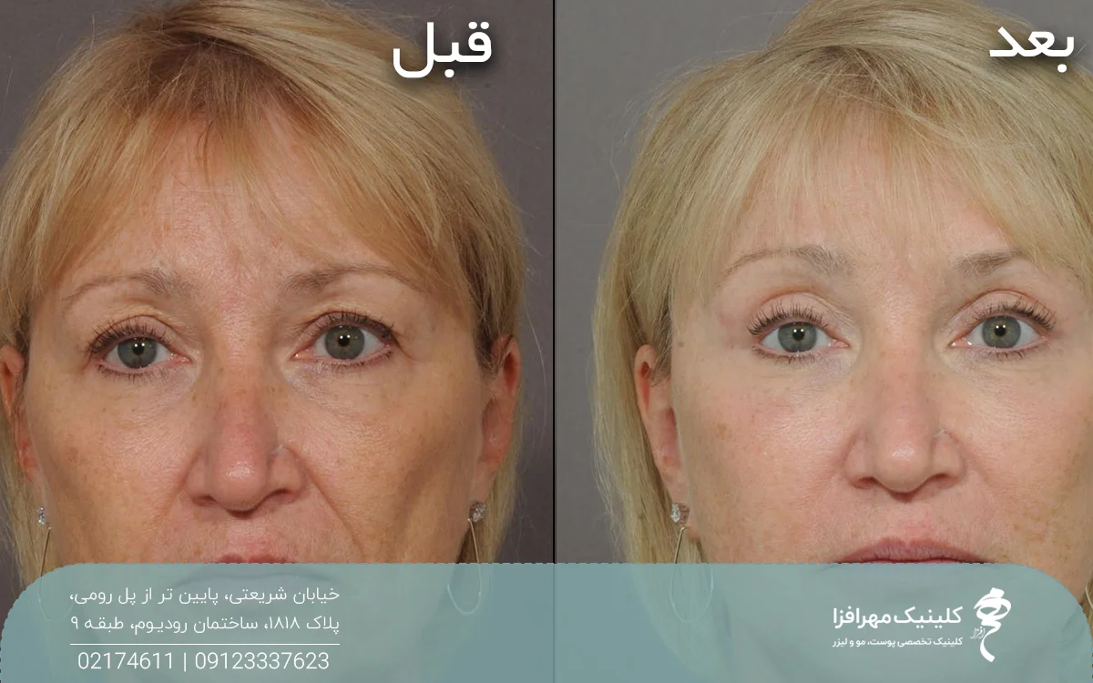 عکس قبل و بعد فردی که تزریق چربی خط خنده انجام داده است