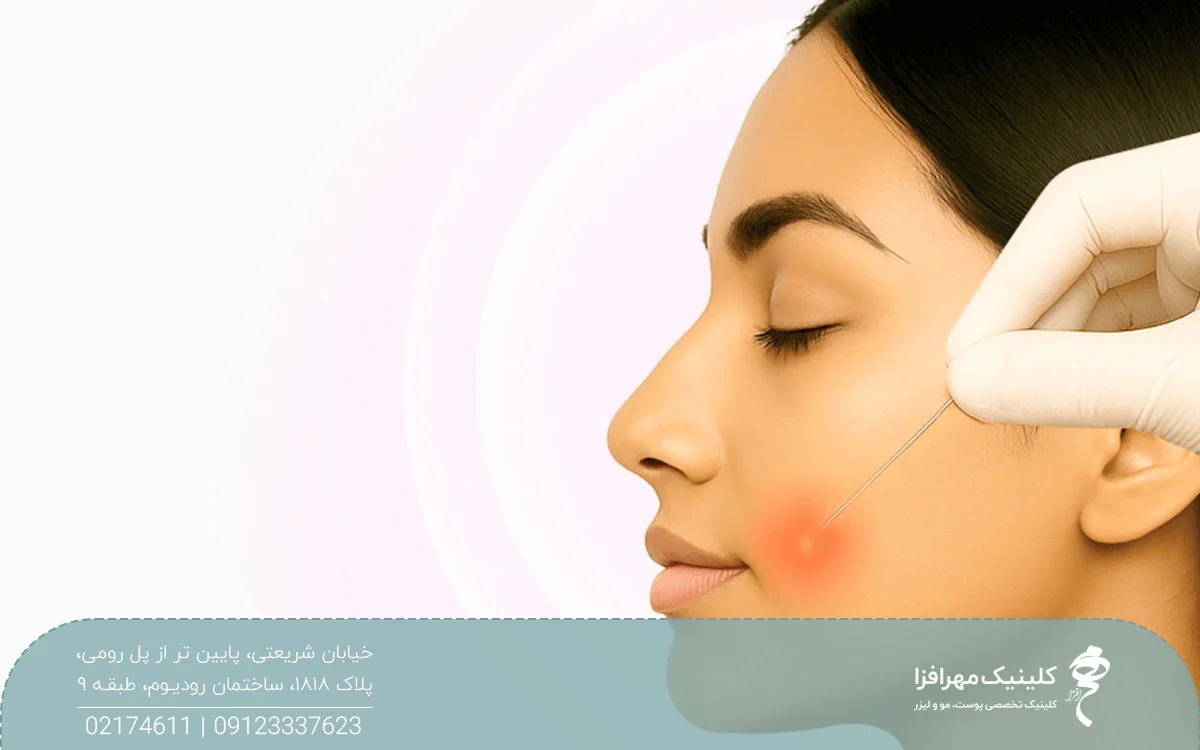 عکس نیم رخ از دختری که میکروفیبر اندولیفت با نور قرمز رنگ لیزر وارد پوست او شده است