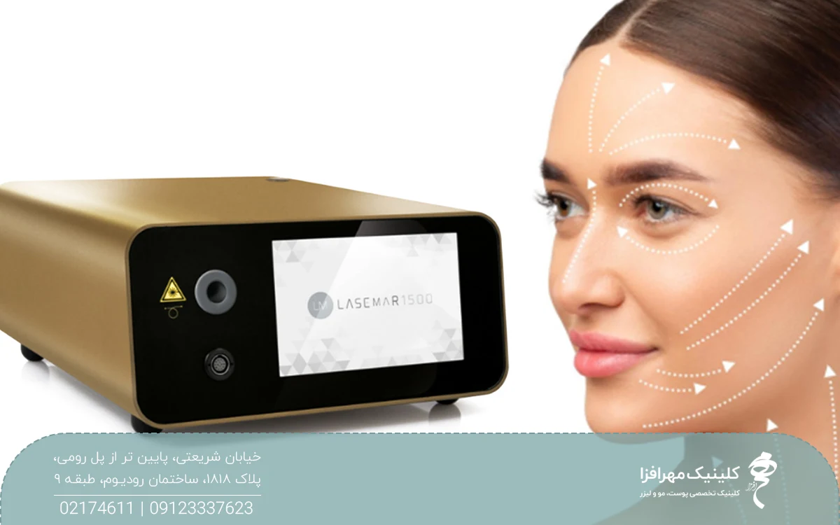 عکس دستگاه اندولیفت یوفوتون در سمت چپ و صورت دختری که خط چین های سفید روی صورت او رسم شده در سمت راست