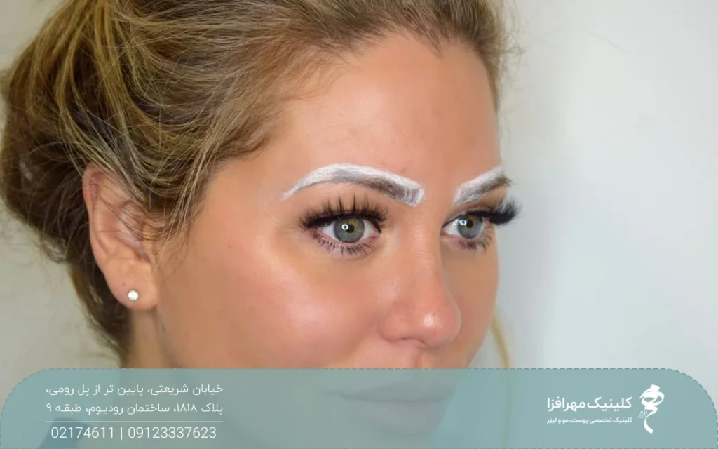 عکس دختری که پیش از کاشت ابرو روی ابروهای او طراحی انجام شده است