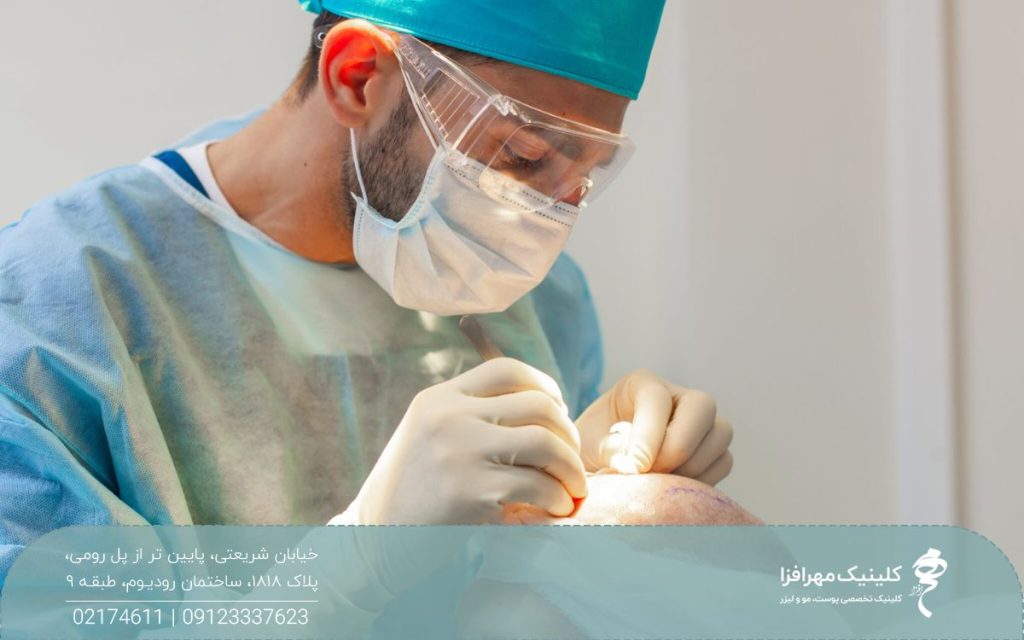 پزشکی که روی سر مراجعه کننده کاشت مو میکروگرافت انجام می دهد