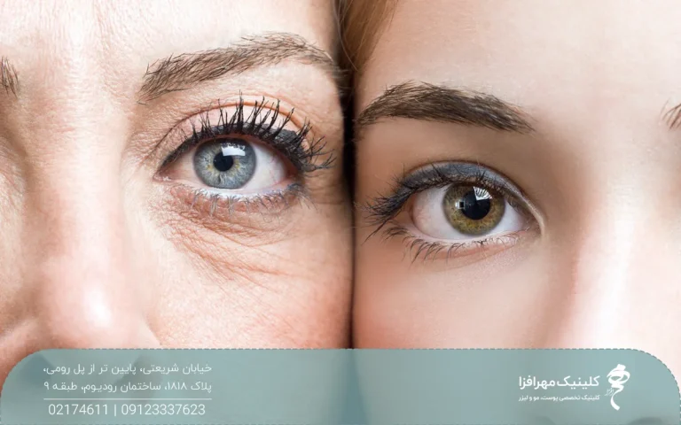 چشم های دو دختر در کنار هم که یکی چشم های جوان و دیگری دور چشم هایش چروک و افتادگی دارد